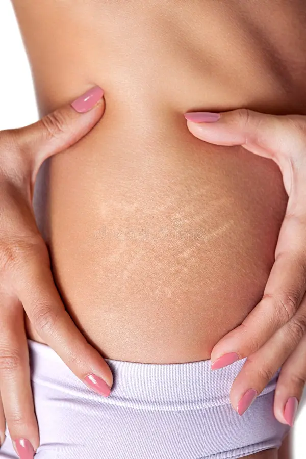 Anti-stretch mark oil therapy